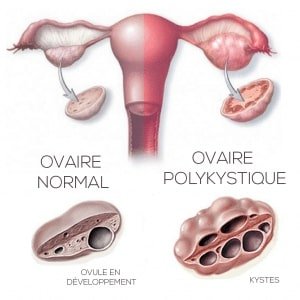 Syndrome des ovaires polykystiques sur Adorablshop
